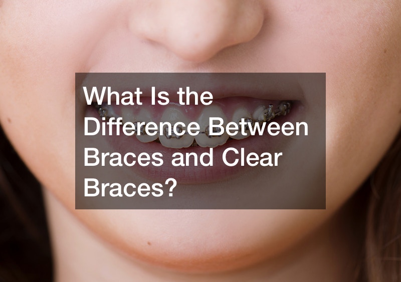 What Is the Difference Between Braces and Clear Braces?
