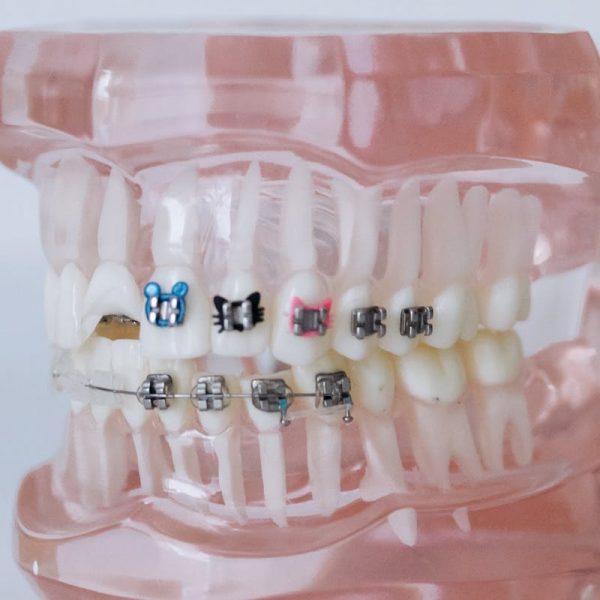 dental braces