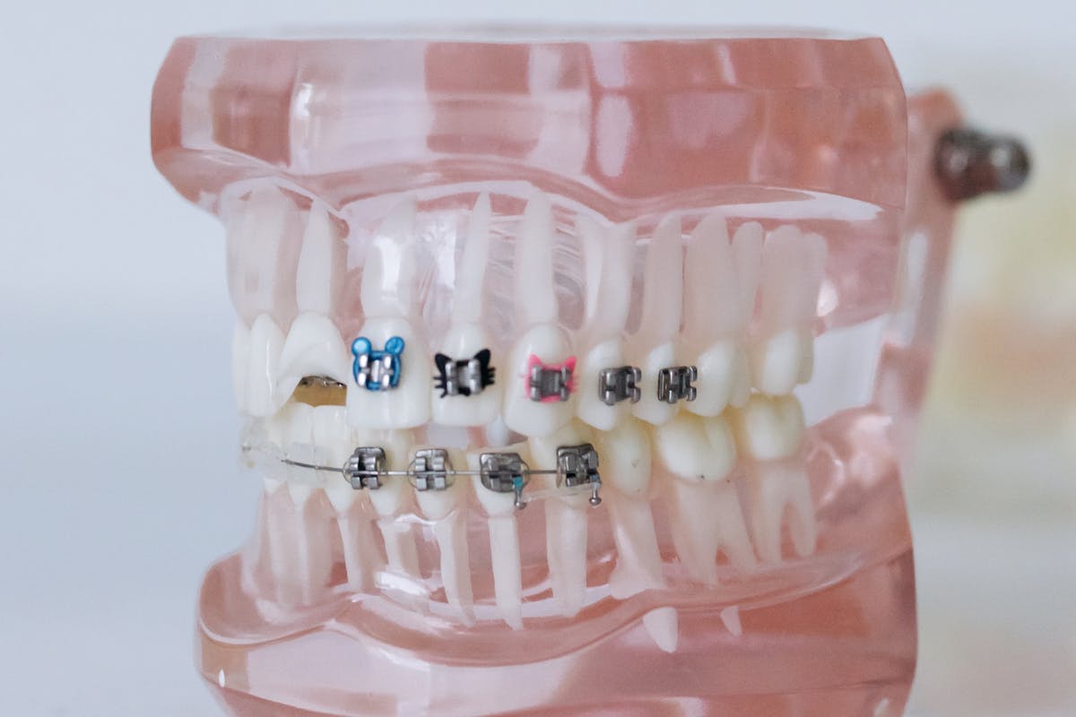 dental braces