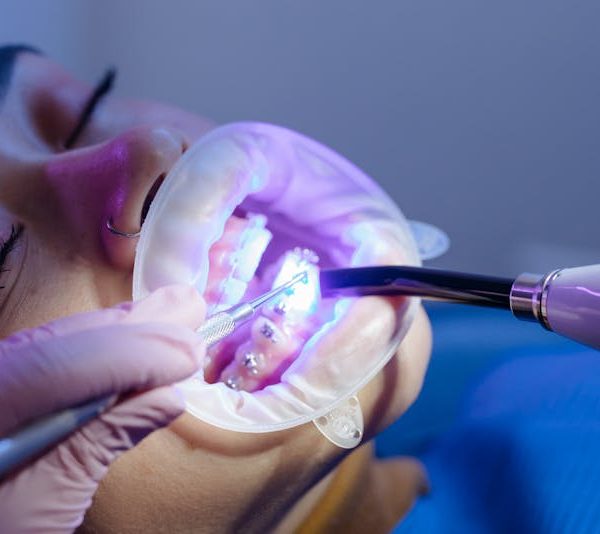 dental braces procedure