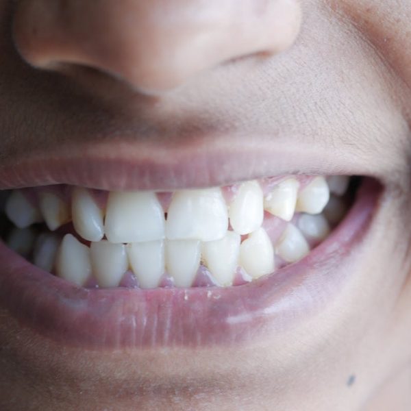 misaligned teeth