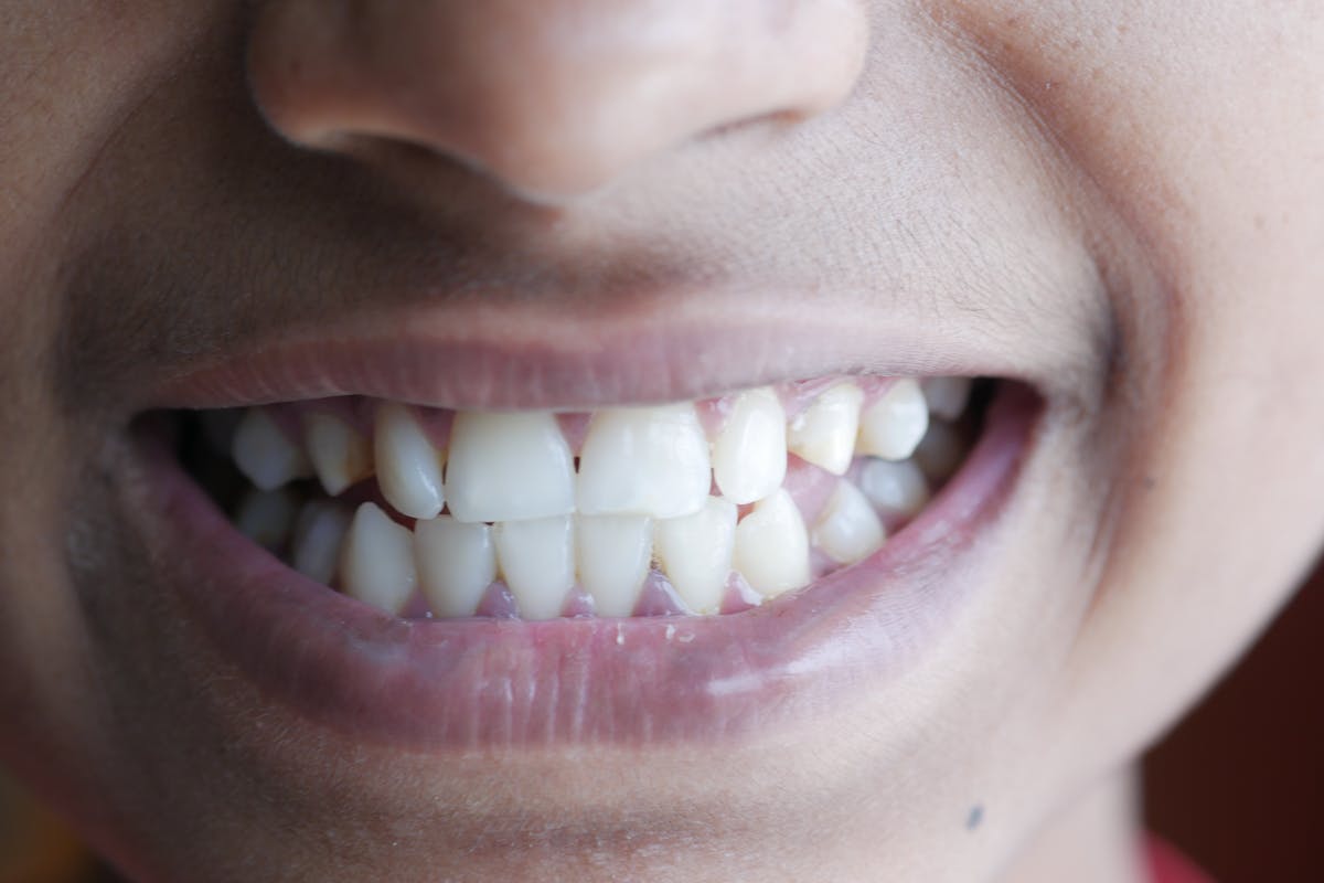 misaligned teeth